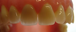 zirconium_oxide_dental_crowns